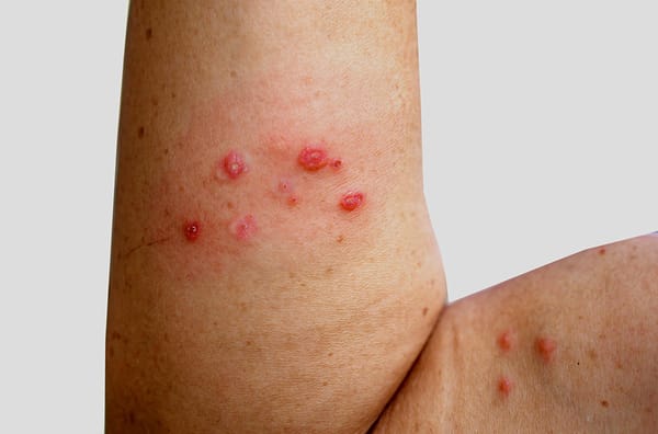 Varíola de macacos: o que sabemos até agora?