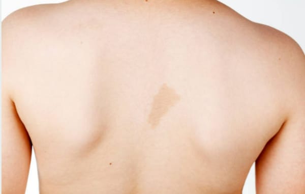 Diagnóstico de Neurofibromatose tipo 1 utilizando os critérios do NIH