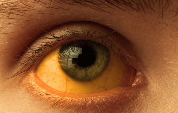 Hepatite A: como diagnosticar?