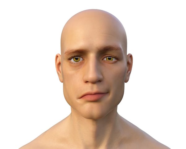 Como ocorre a Paralisia de Bell?