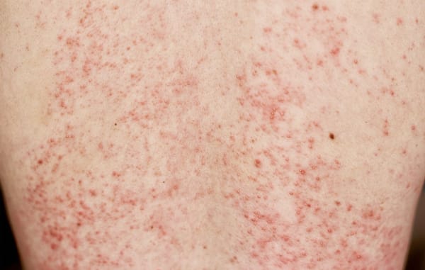 Necrólise Epidérmica Tóxica e Síndrome Stevens-Johnson rash cutâneo