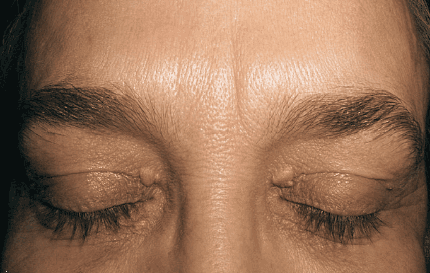 O que é Xantelasma e qual a relação com a Dieta Carnívora?